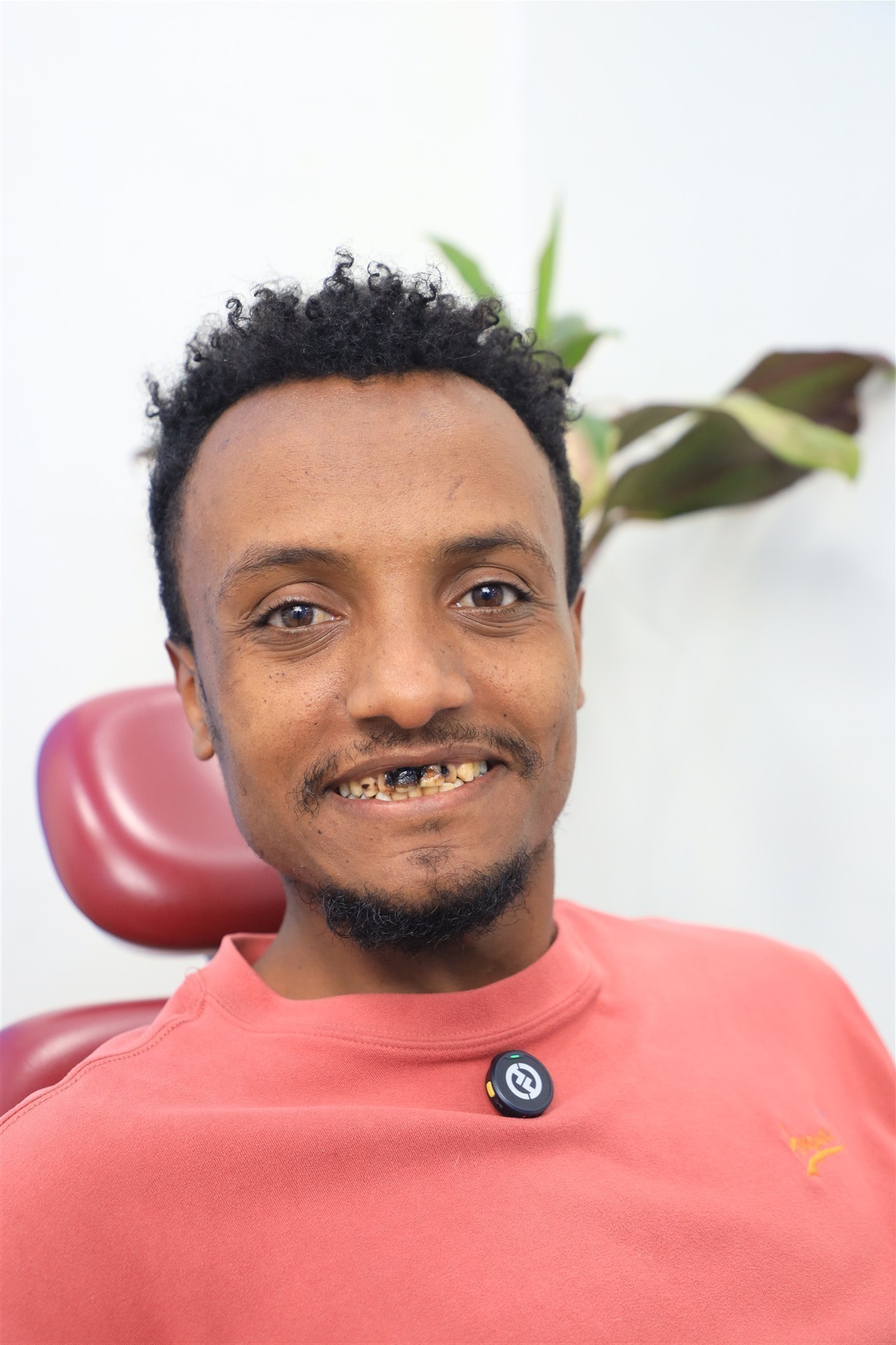 Before orthodontic treatment at Grace Dental